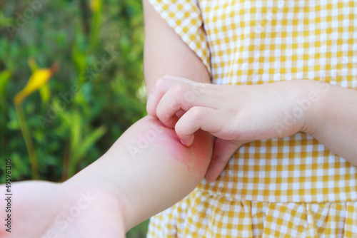 Canvas Print Little girl has skin rash allergy and itchy on her arm