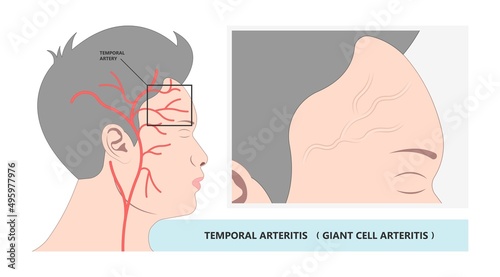 Giant cell takayasu blood Horton's artery scalp swollen brain mini stroke Jaw pain Vision loss double blurry anemia older head viral virus bacteria adult Aortic aorta bell palsy eye Carotid Rheumatoid