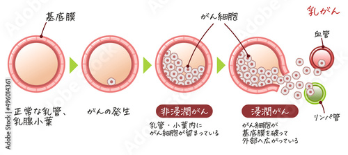乳がん・乳癌・乳ガン・Breast cancer・浸潤がん・非浸潤がんのイラスト