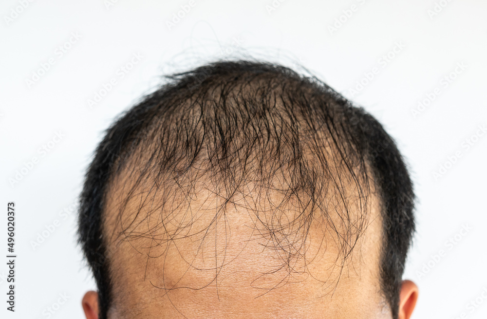 Close up of Asian male pattern baldness. Hair loss (alopecia) can affect just your scalp or your entire body. It can be the result of heredity, hormonal changes or a normal part of aging. Close up of Asian male pattern baldness. Hair loss (alopecia) can affect just your scalp or your entire body. It can be the result of heredity, hormonal changes or a normal part of aging.