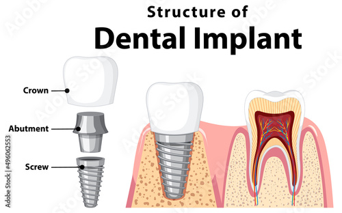 Infographic of human in structure of the dental implant