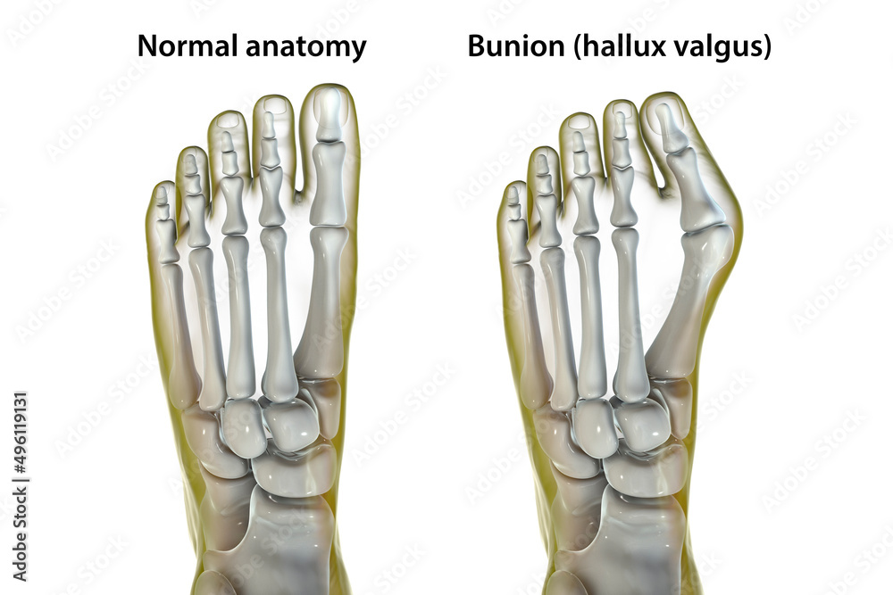 Toe deformation, also known as hallux valgus, or bunion Stock ...
