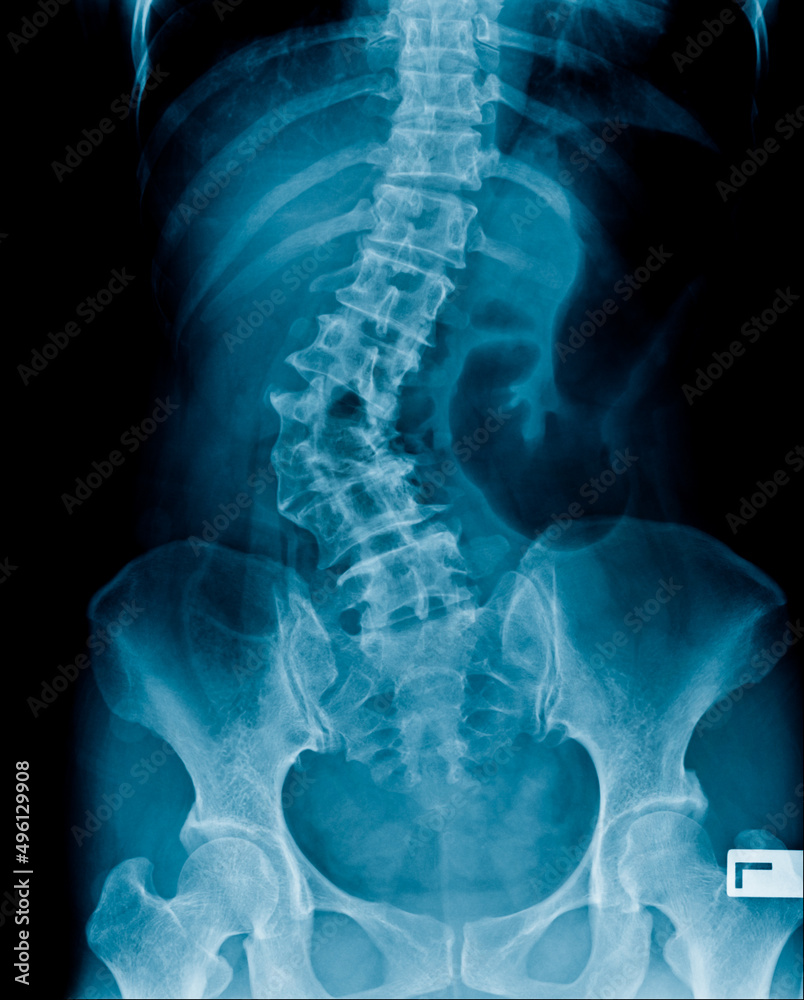 X-ray image of abdomen show spine and pelvic bone, lumbar spondylosis and degenerative change and deformity in scoliosis shape - obrazy, fototapety, plakaty 