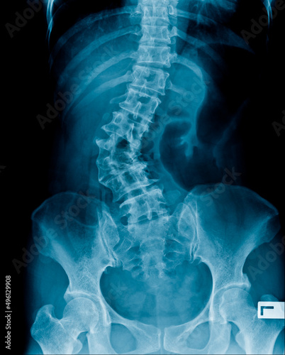 X-ray image of abdomen show spine and pelvic bone, lumbar spondylosis and degenerative change and deformity in scoliosis shape photo