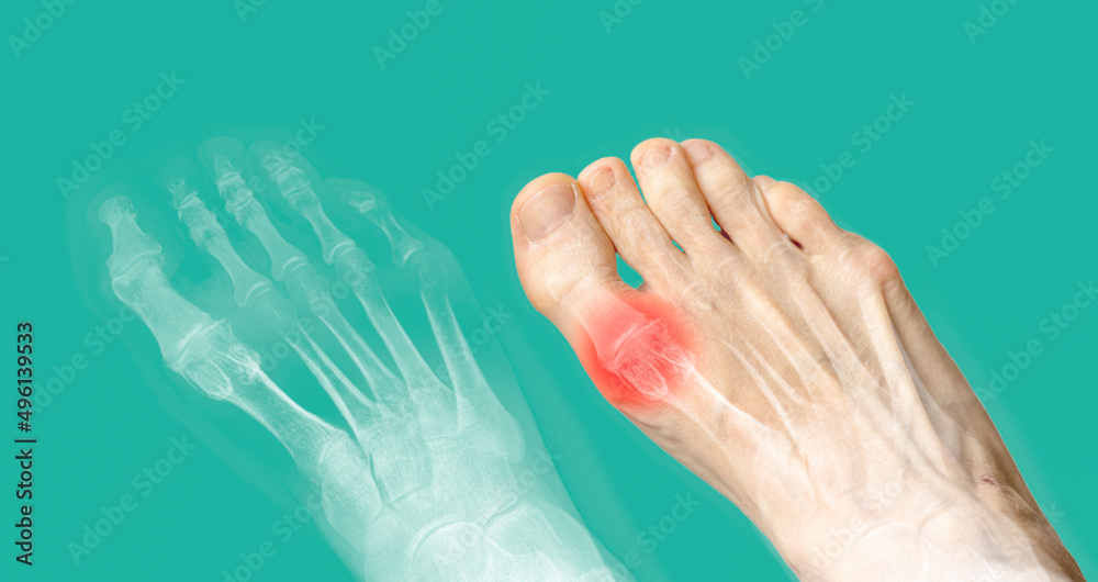 Xray and the same foot with red pain. Rheumatoid arthritis