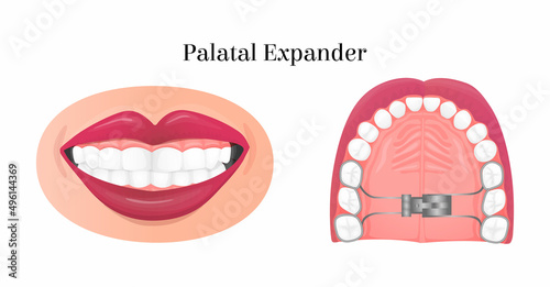 Vector isolated illustration with palatal expander, bottom view. Concept treatment of orthodontic problems, straightening, fixing of teeth, orthodontic structures. It can be used in banner design, web photo