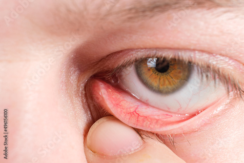 Red lower eyelid, a macro photo of the human eye. Conjunctivitis, inflammation of the mucous membrane of the eye. photo