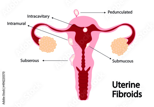 Uterine Fibroids illustration. Fibroids in the uterus also called leiomyomas or myomas photo