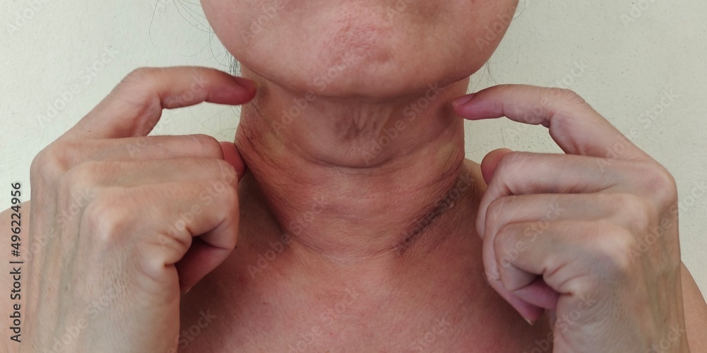 Naklejka premium Portrait showing the fingers holding the flabbiness adipose under the neck, problem wrinkled and cellulite skin under the chin, concept health care.