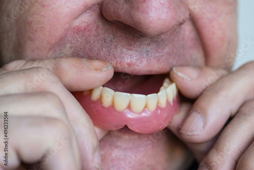 Close-up portrait of a caucasian pensioner wearing dentures. Dental prosthetics. Loss of zkbs in old age.Selective focus