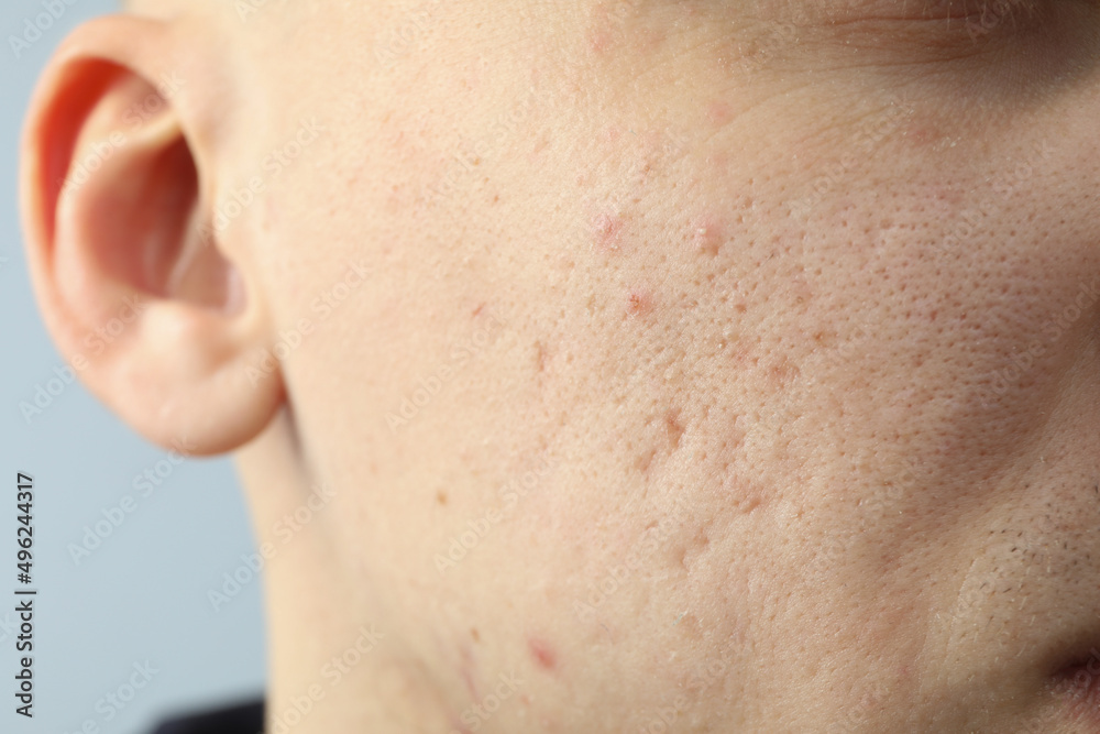 Concept of skin care with problem skin, close up Concept of skin care with problem skin, close up
