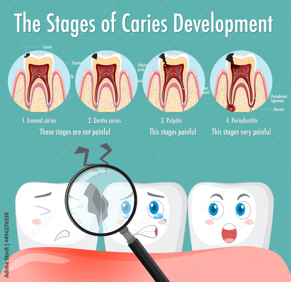 Infographic Of Human In The Stages Of Caries Development Illustration