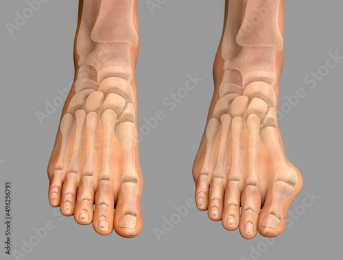 Toe deformation, also known as hallux valgus, or bunion