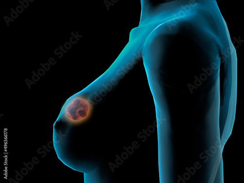 Side profile of a woman suffering from breast cancer