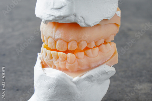 Teeth mold of an underbite malocclusion used for jaw surgery. photo