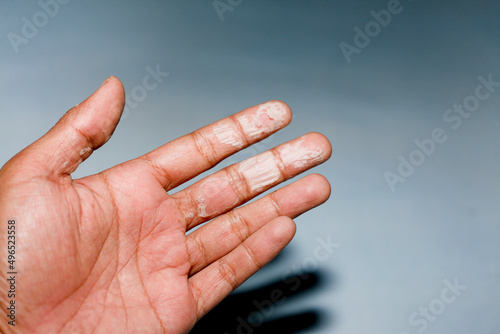 The dry skin in hands, peel, contact dermatitis, fungal infections photo