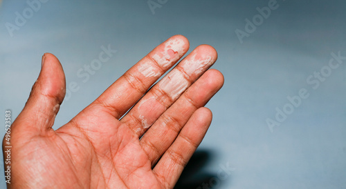 The dry skin in hands, peel, contact dermatitis, fungal infections