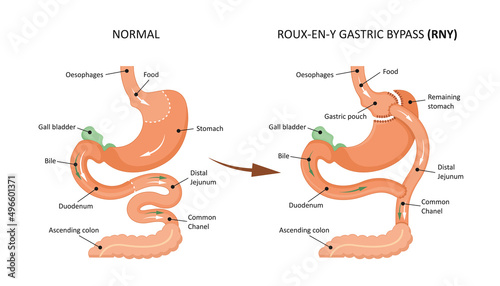 Roux-en-y gastric bypass (RNY). Showing a gastric pouch and gastrojejunal anastomosis. photo