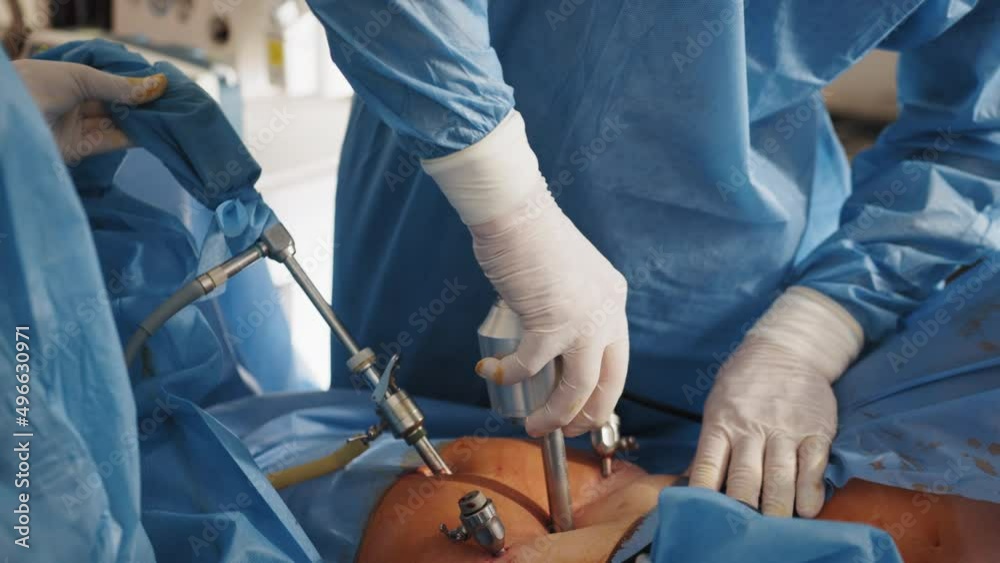 Process of surgery operation using laparoscopic equipment. Instruments for laparoscopic surgery at work. Operating room with surgery equipment. Cancer tumor removal. Process of surgery operation using laparoscopic equipment. Instruments for laparoscopic surgery at work. Operating room with surgery equipment. Cancer tumor removal.