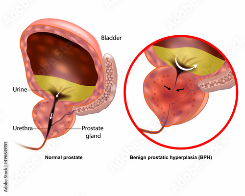 Medical vector illustration showing Benign prostatic hyperplasia BPH and Normal prostate. Prostate gland enlargement photo