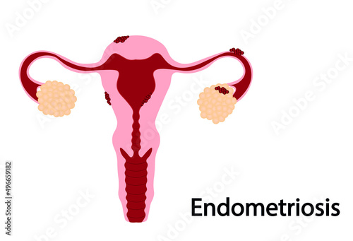 Endometrisis illustration. Uterus with tissue growth in a lot of parts in the organ. 