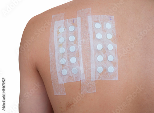 Applying Patch Test to test for chronic allergic rash from chemical exposure through skin. Skin allergy test strips.