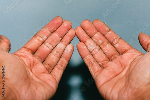 The dry skin in hands, peel, contact dermatitis, fungal infections photo