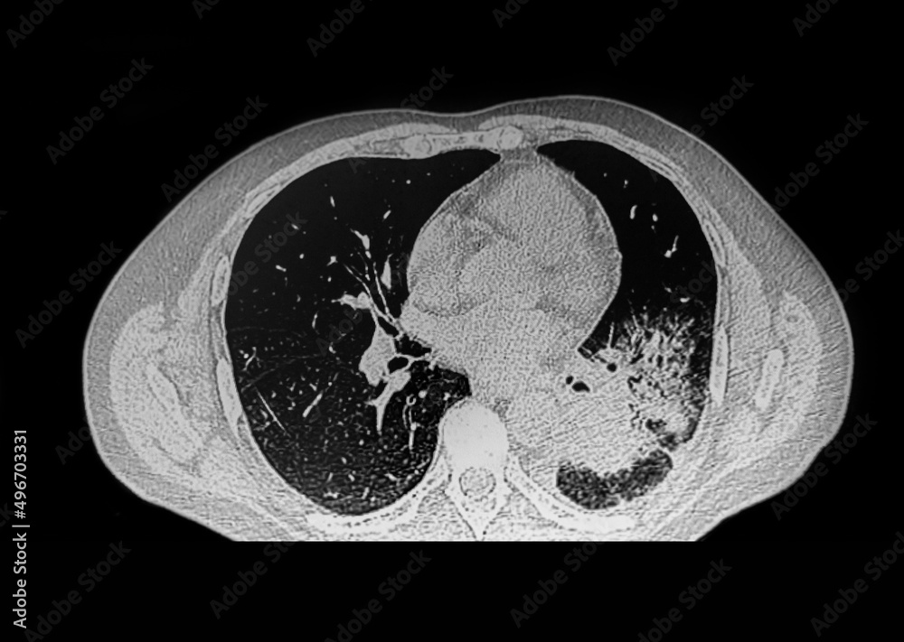 CAT -Scan of male patient with lung tumor. Medical themes.