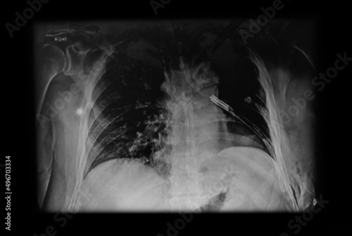 Chest X- ray showing chest tube. Medical themes