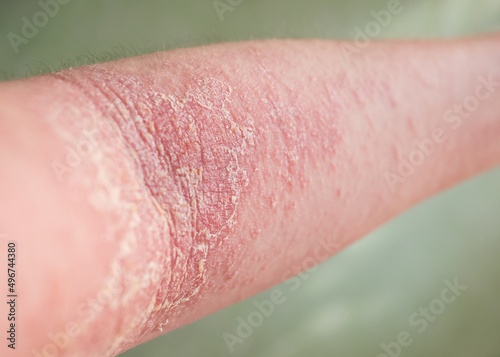 Close-up view of the eczema on a person's arm. photo