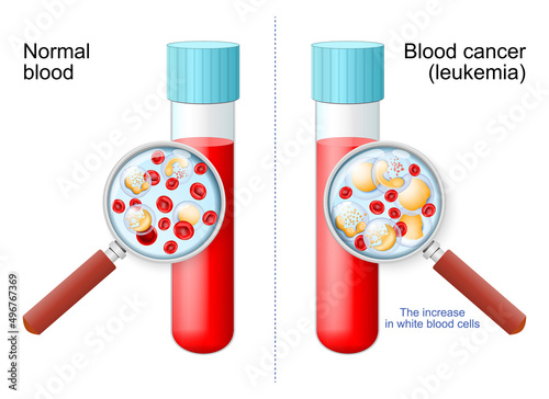 Leukemia. Red and white blood cell in Test tube in magnifying glass.