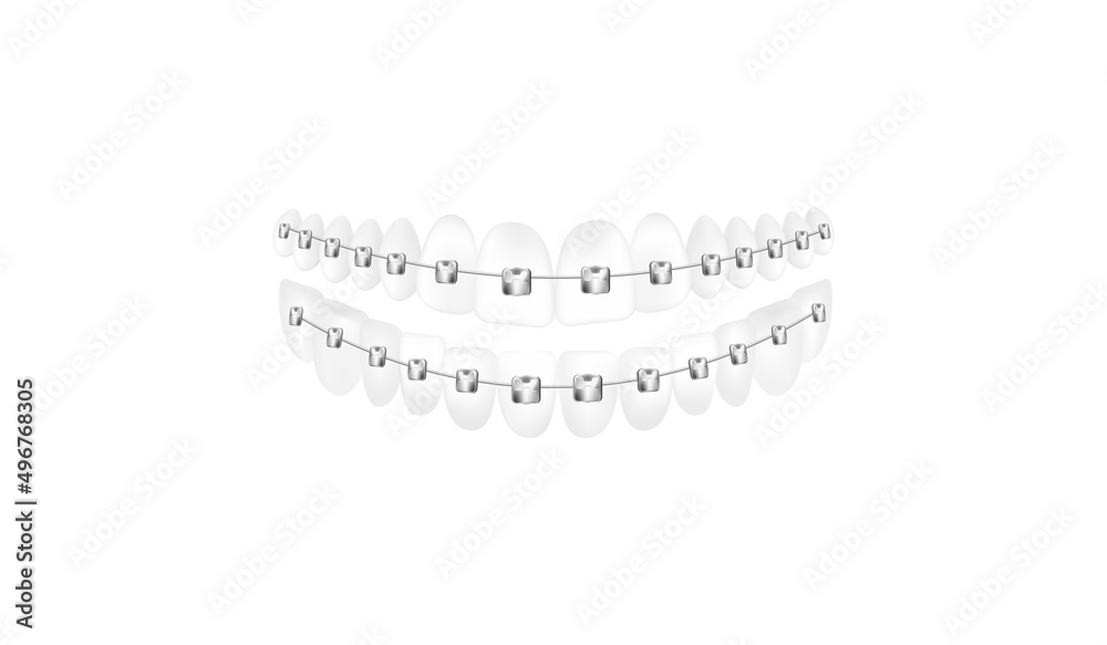 Obraz premium Lower and upper teeth with dental braces, realistic vector illustration isolated.