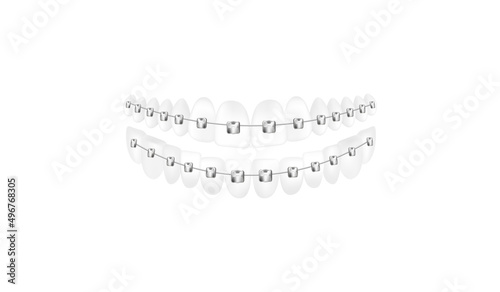 Lower and upper teeth with dental braces, realistic vector illustration isolated.