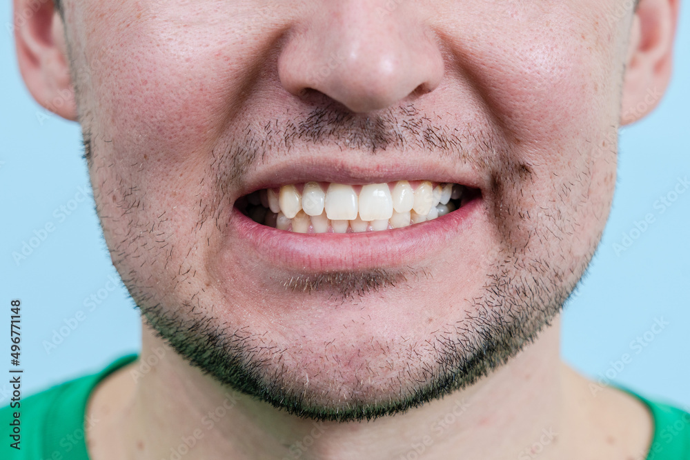 Fototapeta premium Man Teeth After Whitening. Dentist work photo