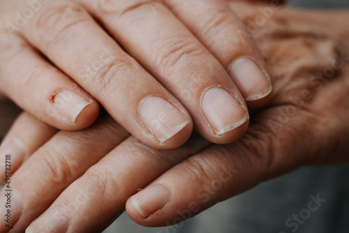 Close-up of senior caucasian woman's hand, damaged nails and dry skin, hangnails and cuticles. Skin disease, dermatology. Macro photo, selective focus photo
