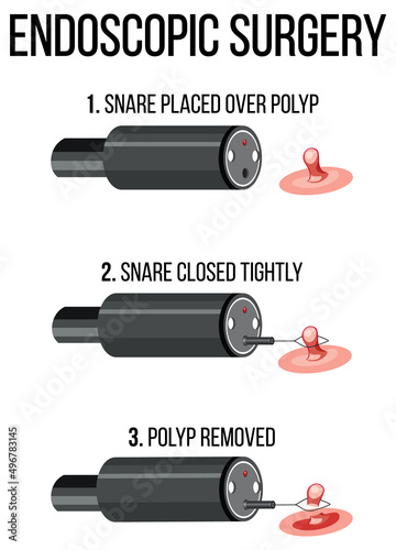 Diagram showing endoscopic surgery