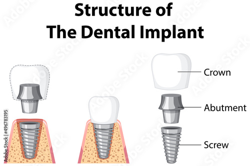 Infographic of human in structure of the dental implant