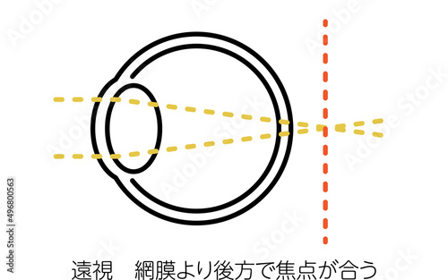 視力と屈折異常のメディカルイラスト、遠視（網膜より後方で焦点が合う）