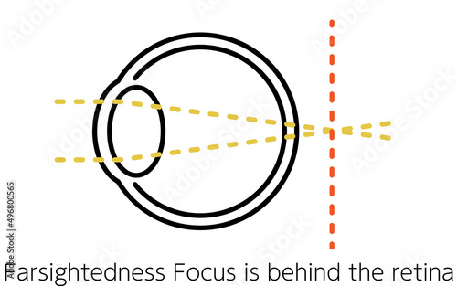 視力と屈折異常のメディカルイラスト、遠視（網膜より後方で焦点が合う）