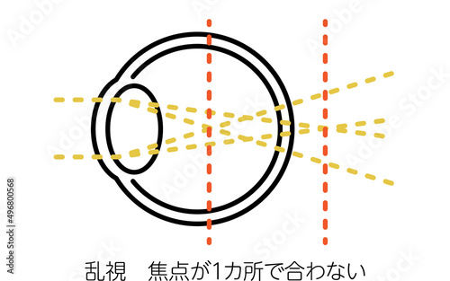視力と屈折異常のメディカルイラスト、乱視（焦点が1カ所で合わない）