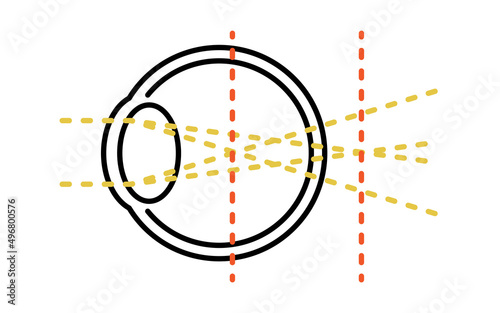 視力と屈折異常のメディカルイラスト、乱視（焦点が1カ所で合わない）