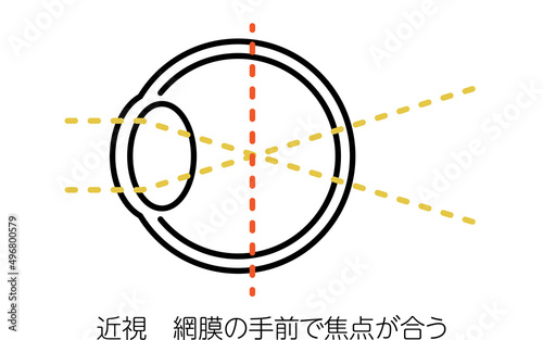 視力と屈折異常のメディカルイラスト、近視（網膜の手前で焦点が合う）
