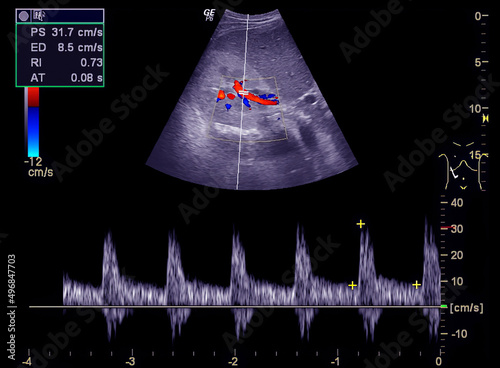 Ultrasound upper abdomen showing flow in common bile duct  after use color Doppler. photo