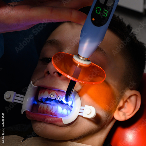 Alignment of crooked teeth with the help of braces, installation of braces for a child, an orthodontist glues metal plates braces for teeth alignment. photo