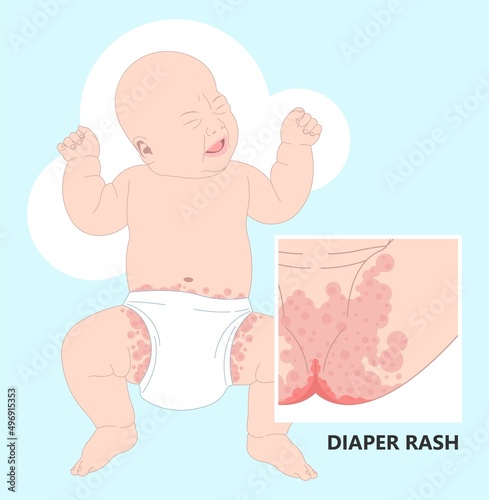 Skin rash allergy hives food cloth staph heat red thrush burn cream bacterial bottom infant newborn child kids wet wear clean thigh treat prevent itchy pain baby oils care home chafe sore leg bleed