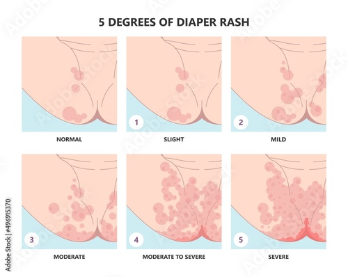 Skin rash allergy hives food cloth staph heat red thrush burn cream bacterial bottom infant newborn child kids wet wear clean thigh treat prevent itchy pain baby oils care home chafe sore leg bleed
