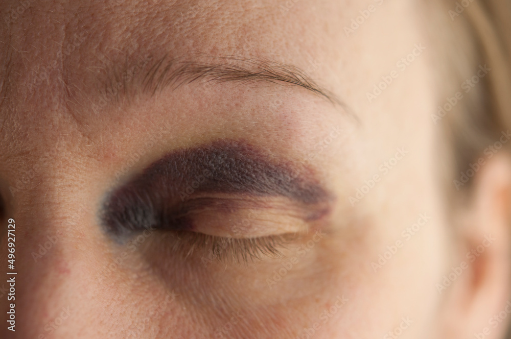 Sad beaten up girl with wounds on the face looking at the camera with deep look Sad beaten up girl with wounds on the face looking at the camera with deep look
