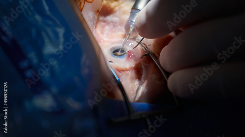 Operacja zaćmy, katarakta, zbliżenie operowanej gałki ocznej, sala operacyjna, blok operacyjny photo