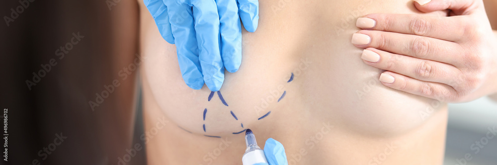 Fototapeta premium Plastic surgeon drawing preoperative markings on patient chest closeup