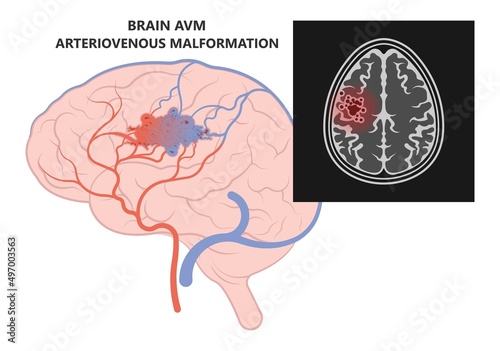 mri diagnose brain artery veins scalp ct scan X-ray image Blood AVM flow stroke Loss of optic nerve pain head galen swelling tangle capillaries system nidus cerebral attack Transient dural fistula